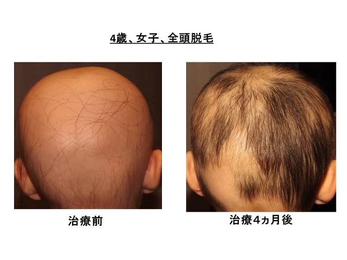 円形脱毛症　病院""